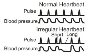Irregular Heartbeat